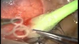 Parásitos en el ojo